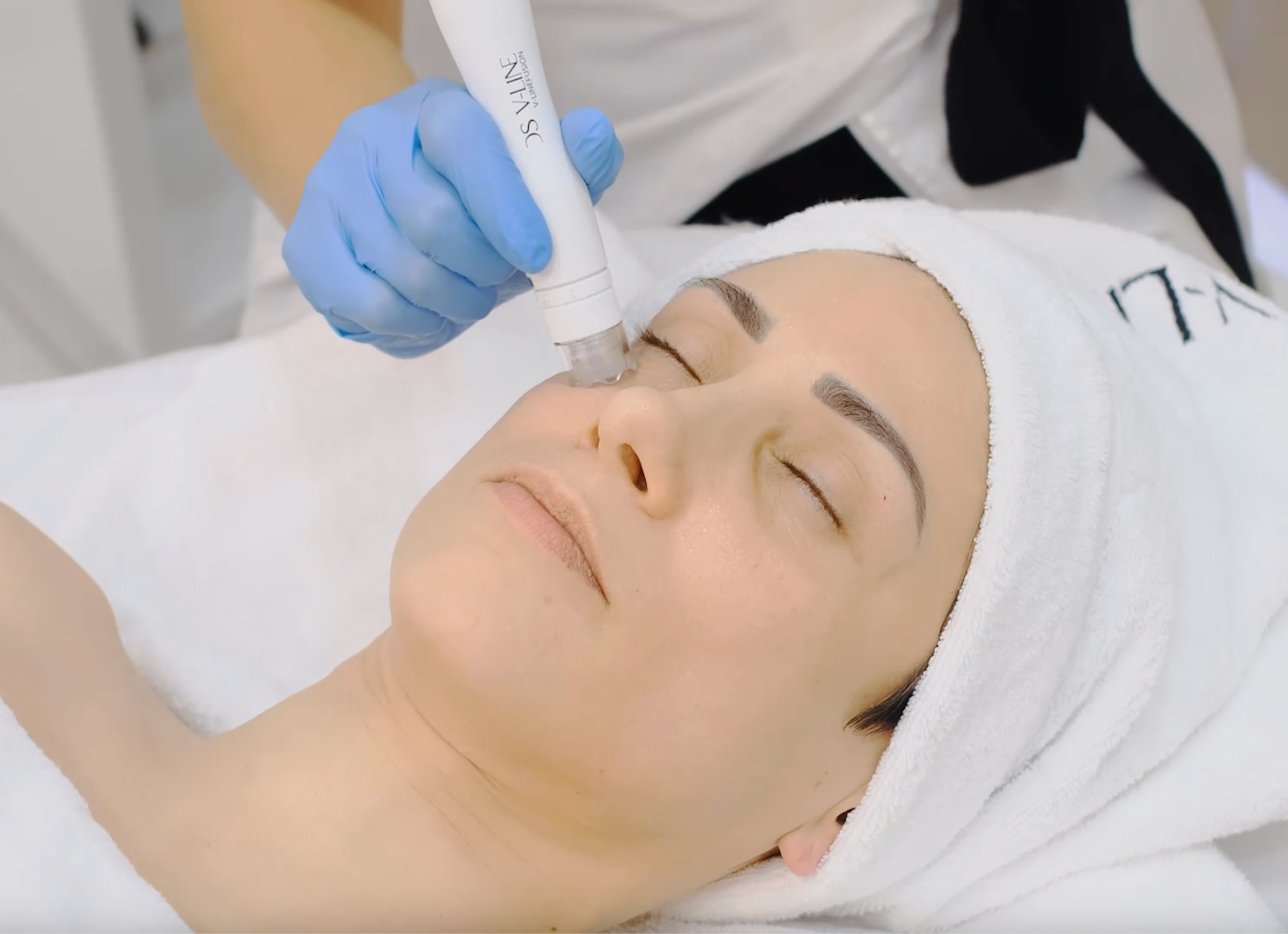 Why is "Microneedling" So Popular for Facial Rejuvenation?