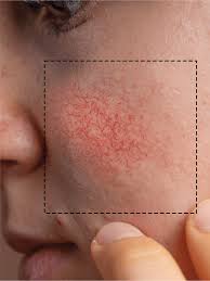 Could It Be Rosacea? Understanding the Symptoms and Care