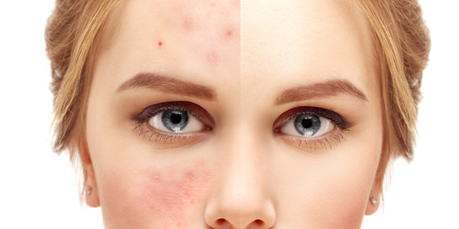 The Ultimate Acne Solution Guide: Effective Treatments and Prevention Tips